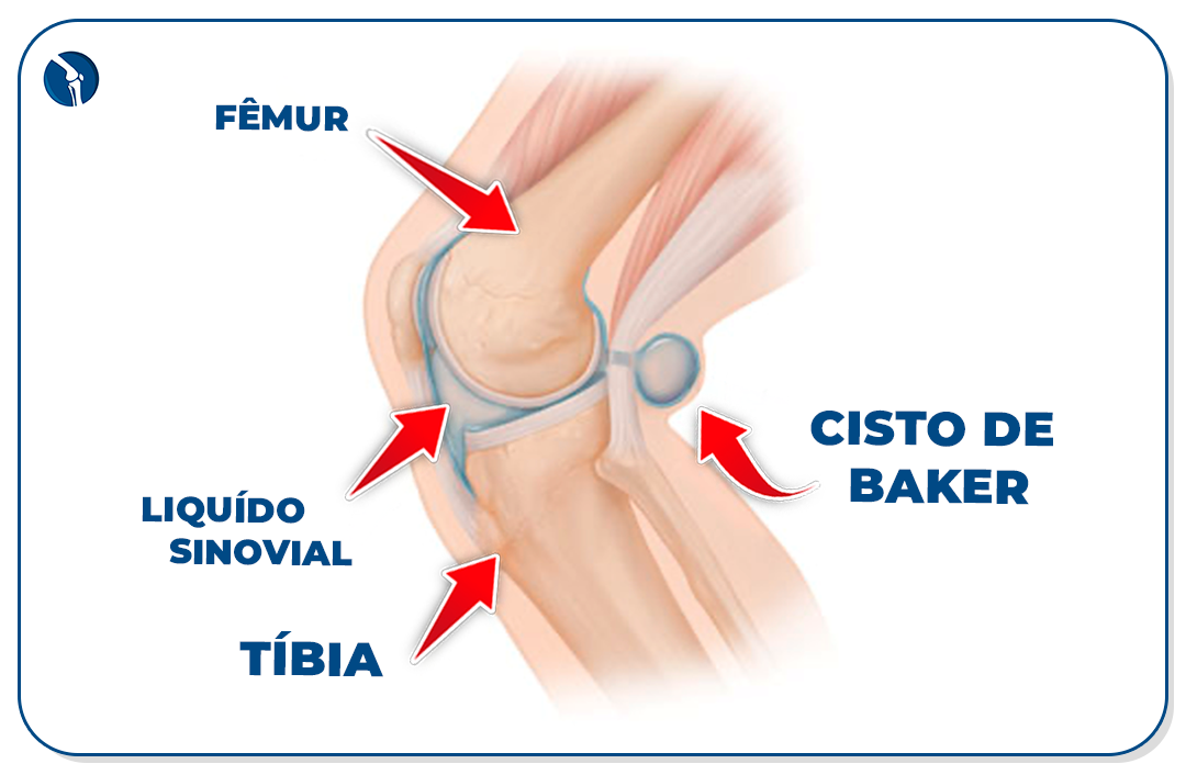 Líquido sinovial e formação do cisto de Baker