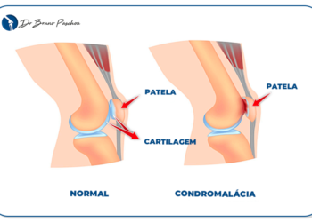 Anatomia da articulação femoropatelar e dor no joelho