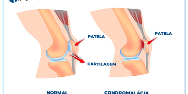 Anatomia da articulação femoropatelar e dor no joelho
