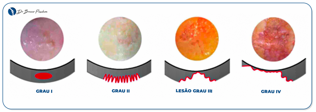Graus da condromalácia patelar