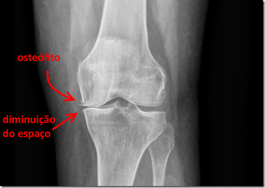 Radiografia mostrando redução do espaço entre os ossos do joelho