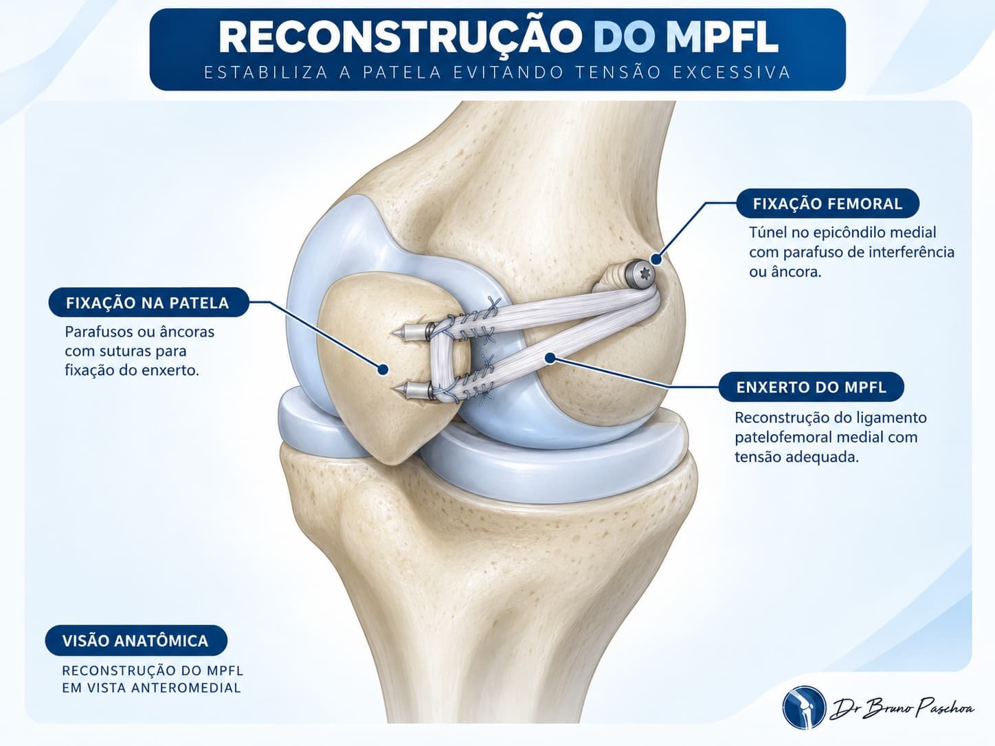 Reconstrução do ligamento patelofemoral medial