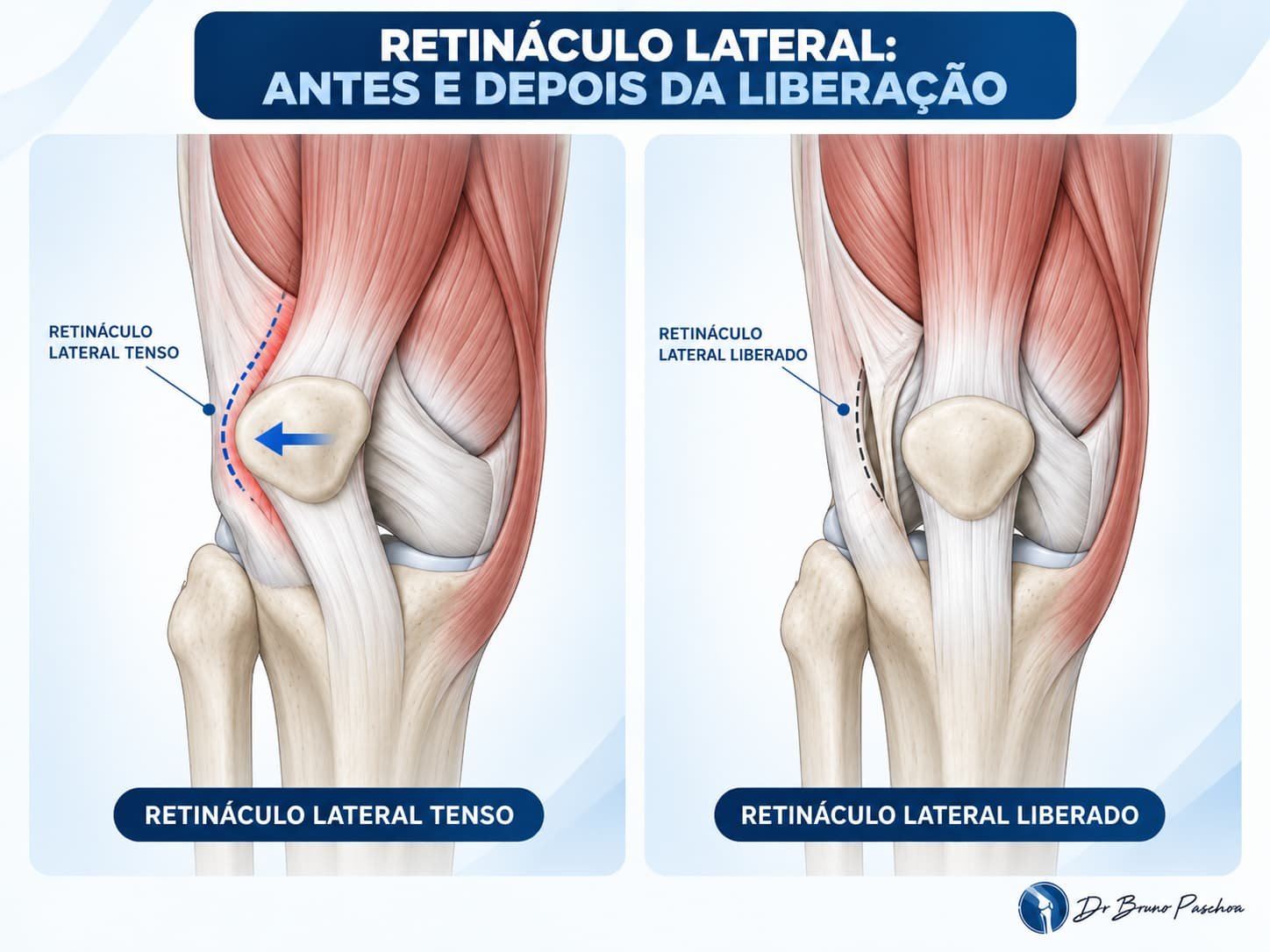 Retináculo lateral antes e depois da liberação