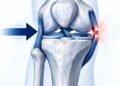 Trauma em valgo do joelho e ruptura do ligamento colateral medial