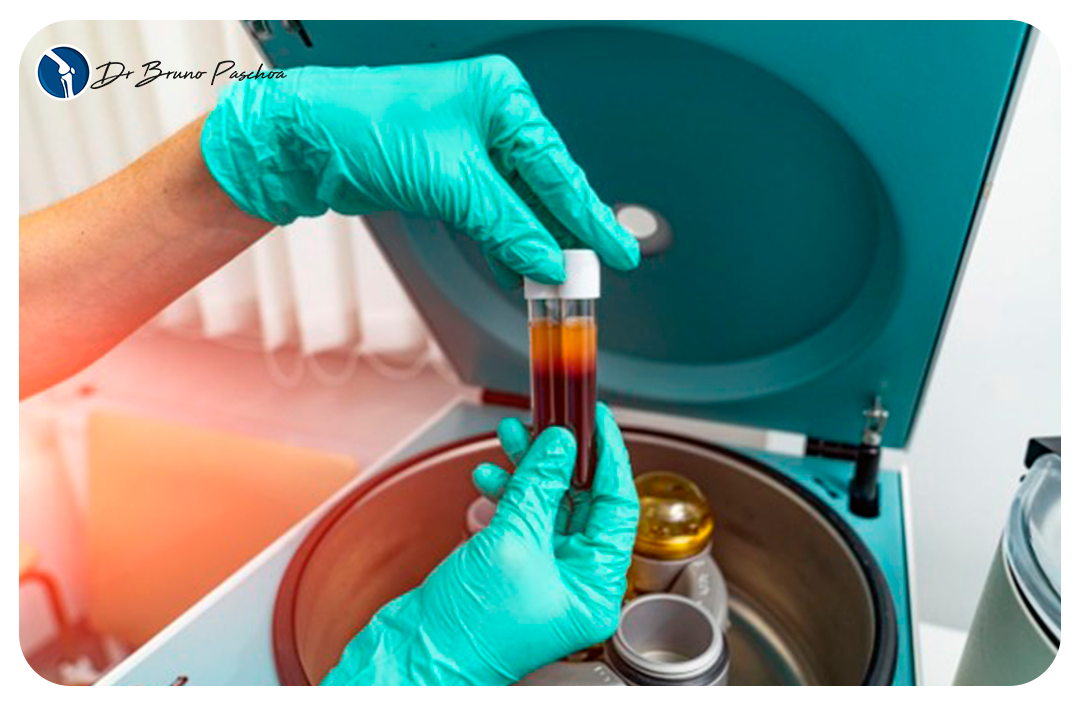 Centrifugação de plasma para infiltração